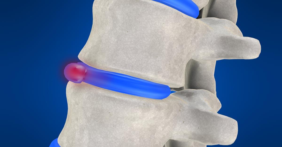 Spinal decompression therapy in Gadsden, AL