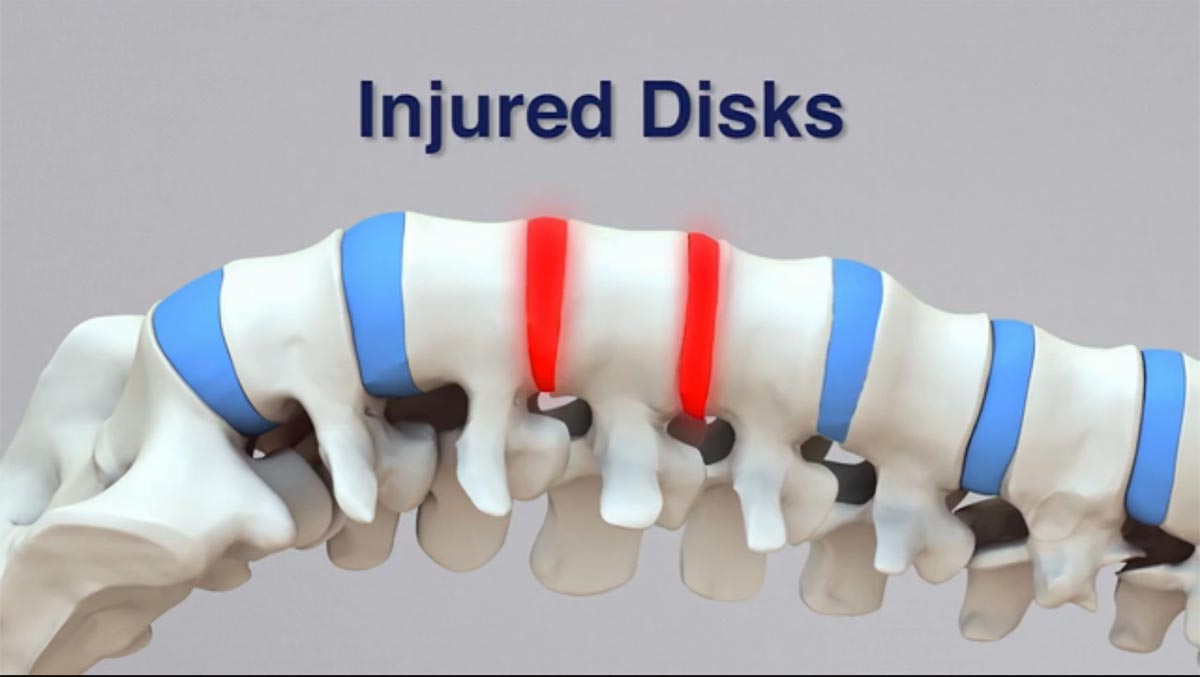 Gadsden, AL non-surgical spinal decompression